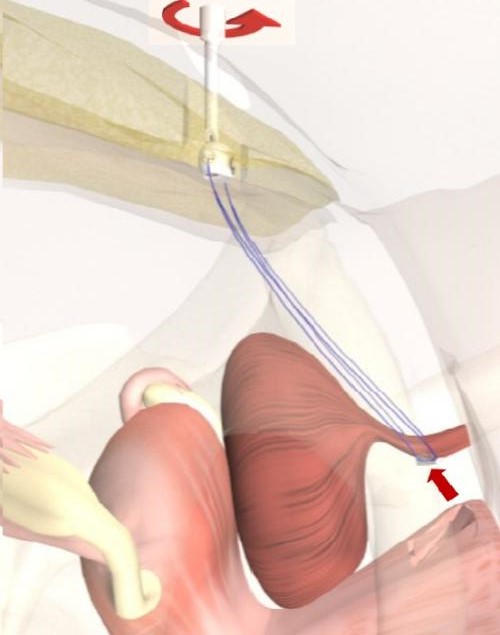 Can the urethral sling surgery stop urine leakage?