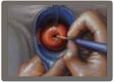 Treatment for pre-cancer cervix (abnormal PAPs)