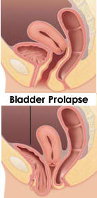 Bladder Prolapse
