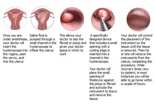 Endometrial (Uterine) Polyp: When to Remove vs. Wait