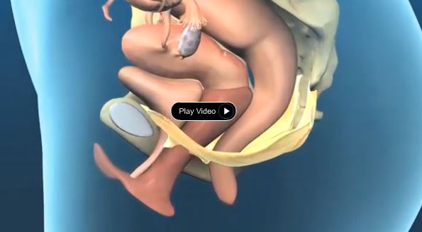 Pelvic Organ Prolapse Video